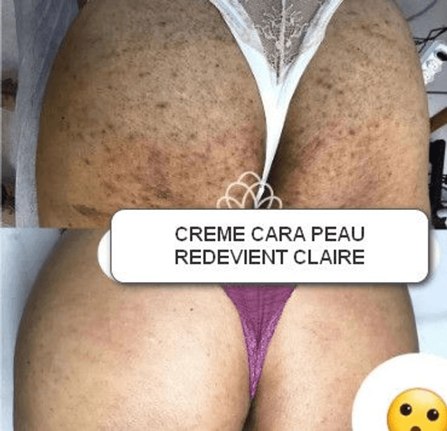 Creme éclaircissant pour cuisses,coude,taches