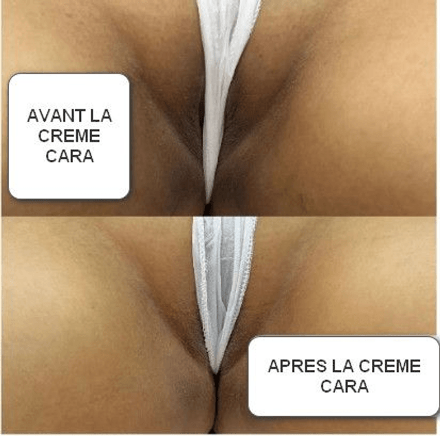 Creme éclaircissant pour cuisses,coude,taches
